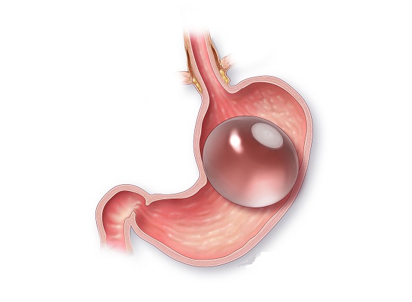 آیا بالون&zwnj;های معده آینده کاهش وزن هستند؟