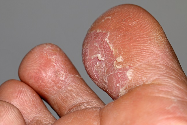 از حمله درماتوفیت ها تا بیماری پای ورزشکاران! از حمله درماتوفیت ها تا بیماری پای ورزشکاران!